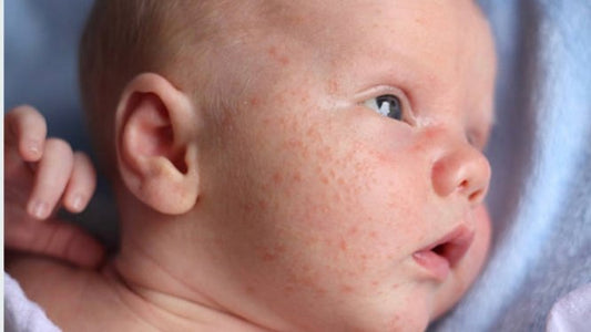 What is baby acne and how to treat it - Ziggy's Pudding