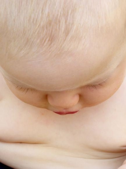What is Seborrheic Dermatitis - Ziggy's Pudding